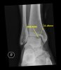 right ankle x-ray.jpg